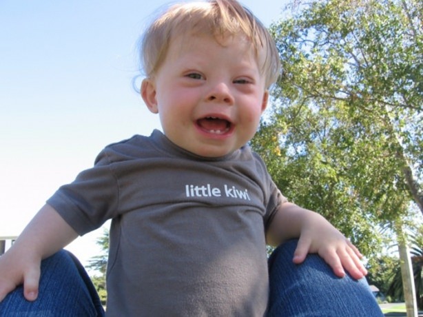 Foto - 21 adımda down sendromu 