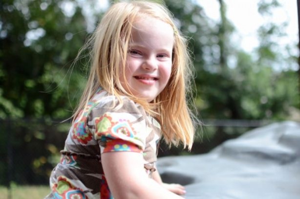 Foto - 21 adımda down sendromu 