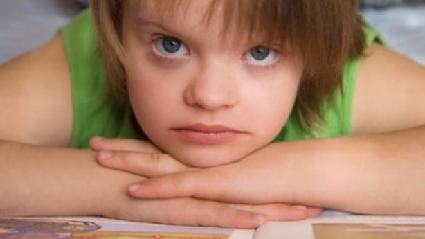 Foto - 21 adımda down sendromu 