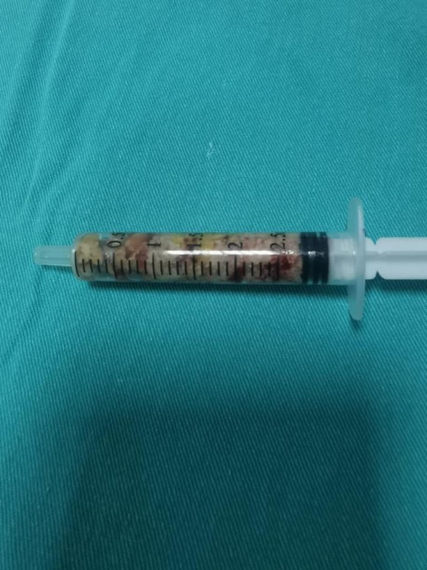 Foto - Tıp dünyası şaşkın! 13 aylık bebeğin böbreğinde bunun ne işi var?