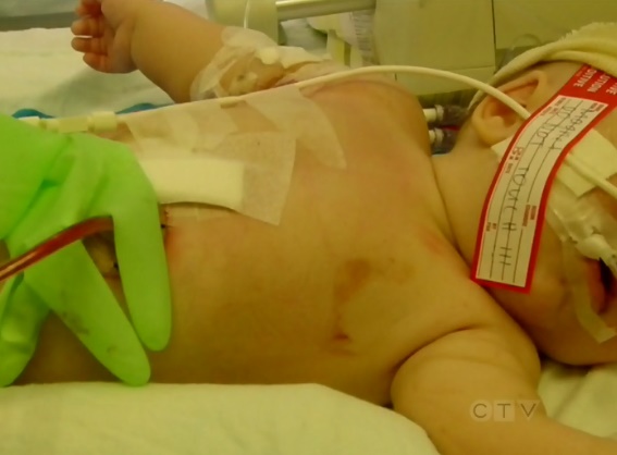 Foto - Tıp dünyasında bir ilk! Mıknatısla tutturdular