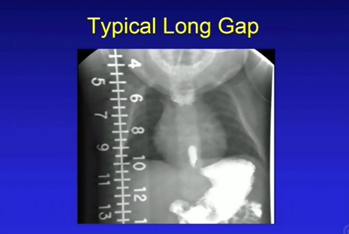 Foto - Tıp dünyasında bir ilk! Mıknatısla tutturdular