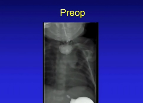 Foto - Tıp dünyasında bir ilk! Mıknatısla tutturdular