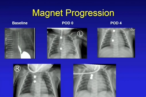 Foto - Tıp dünyasında bir ilk! Mıknatısla tutturdular