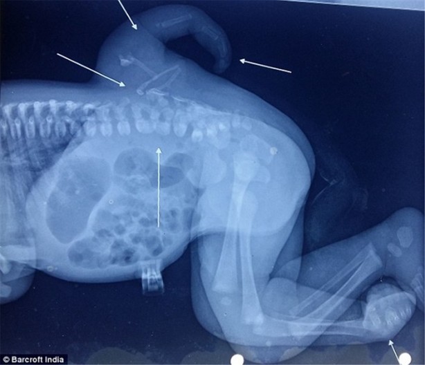 Foto - Tıp dünyasını şaşırtan olay!