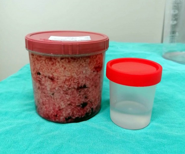 Foto - Tıp tarihinde nadir rastlanıyor! ‘22 yıllık doktorum böylesini görmedim’