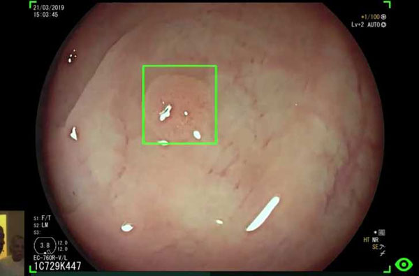 Foto - Tıpta çığır açan teknoloji! Artık yapay zeka ile tespit edilebilecek