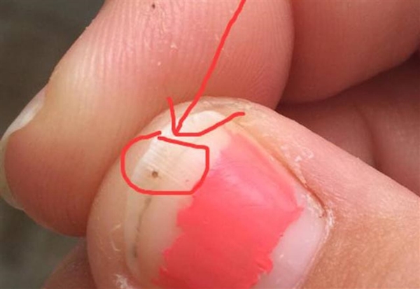 Tırnağındaki siyah noktadan şüphelendi! Bakın ne çıktı...