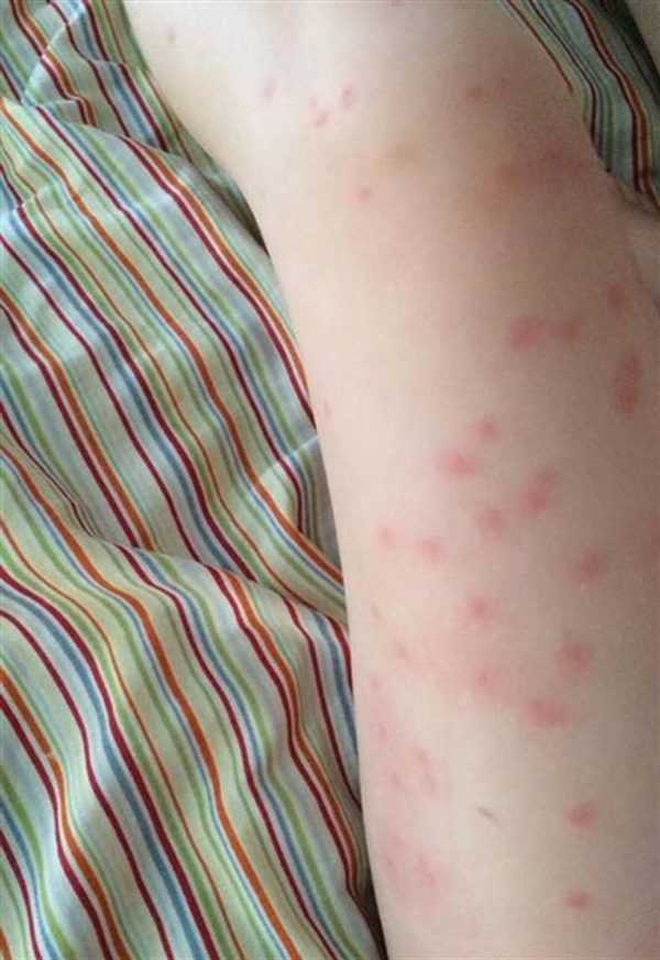 Foto - Tırnağındaki siyah noktadan şüphelendi! Bakın ne çıktı...