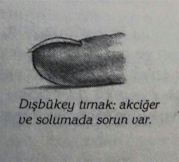 Foto - Tırnağınızın şekli hastalıklarınızı gösteriyor