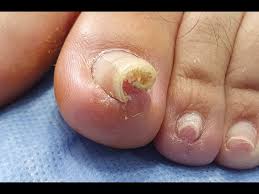 Foto - Tırnak batması için ezber bozan tarifi görenler şaşkına döndü: İyi gelen şeyler! Şaşkına çeviren yöntemler