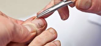 Foto - Tırnak batması için ezber bozan tarifi görenler şaşkına döndü: İyi gelen şeyler! Şaşkına çeviren yöntemler