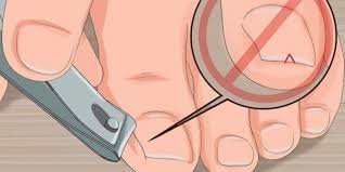 Foto - Tırnak batması için ezber bozan tarifi görenler şaşkına döndü: İyi gelen şeyler! Şaşkına çeviren yöntemler