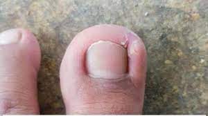 Foto - Tırnak batması için ezber bozan tarifi görenler şaşkına döndü: İyi gelen şeyler! Şaşkına çeviren yöntemler