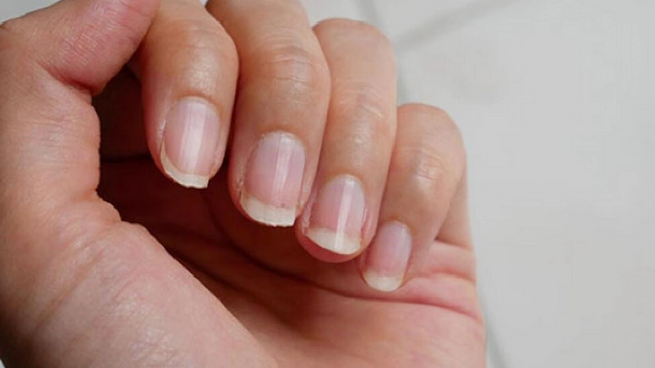 Foto - Tırnak diplerine dikkat! Eğer öyleyse bakın hangi hastalıkların habercisiymiş: Dibinden değiştiriyor! Öyle bir tehlikesi var ki...