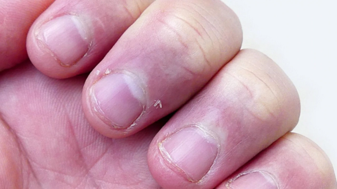 Foto - Tırnak diplerine dikkat! Eğer öyleyse bakın hangi hastalıkların habercisiymiş: Dibinden değiştiriyor! Öyle bir tehlikesi var ki...