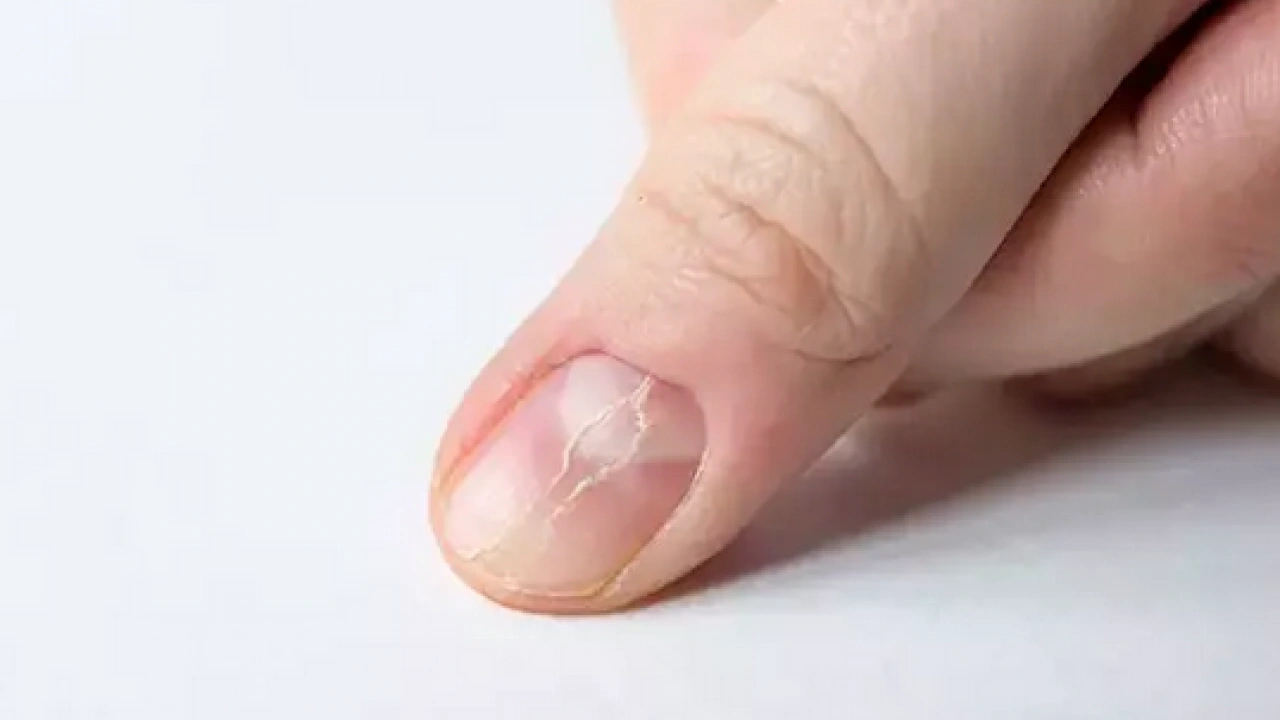 Tırnak diplerine dikkat! Eğer öyleyse bakın hangi hastalıkların habercisiymiş: Dibinden değiştiriyor! Öyle bir tehlikesi var ki...