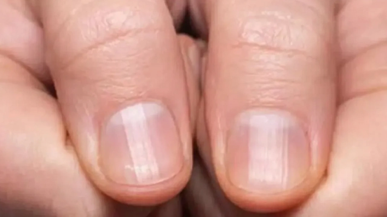 Foto - Tırnak diplerine dikkat! Eğer öyleyse bakın hangi hastalıkların habercisiymiş: Dibinden değiştiriyor! Öyle bir tehlikesi var ki...