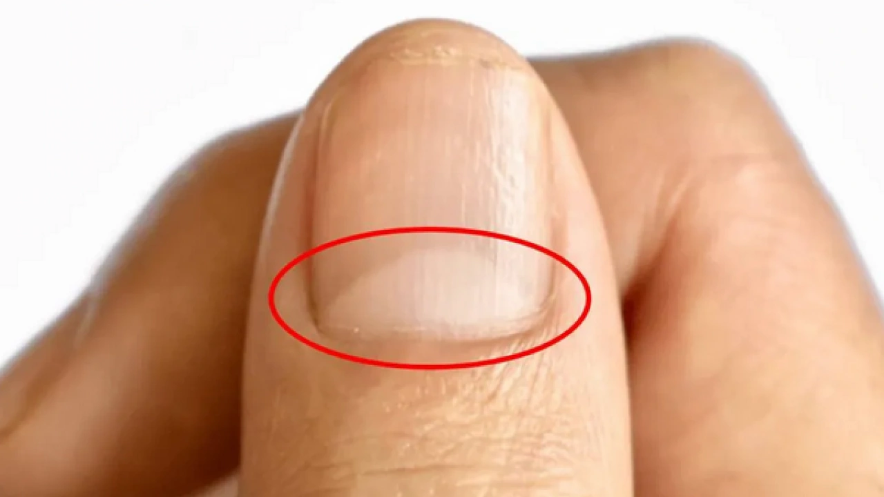 Foto - Tırnak diplerine dikkat! Eğer öyleyse bakın hangi hastalıkların habercisiymiş: Dibinden değiştiriyor! Öyle bir tehlikesi var ki...