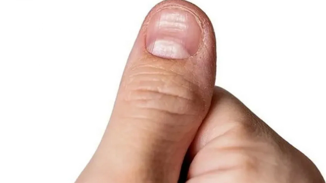 Foto - Tırnak diplerine dikkat! Eğer öyleyse bakın hangi hastalıkların habercisiymiş: Dibinden değiştiriyor! Öyle bir tehlikesi var ki...