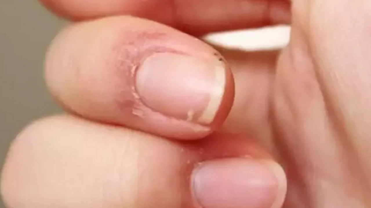 Foto - Tırnak diplerine dikkat! Eğer öyleyse bakın hangi hastalıkların habercisiymiş: Dibinden değiştiriyor! Öyle bir tehlikesi var ki...