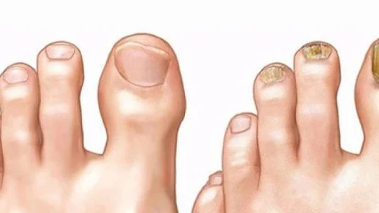 Tırnak mantarı için bitkisel tedavi: Ayak altına yapın, bu yöntemle 3 günde kurtulun! 