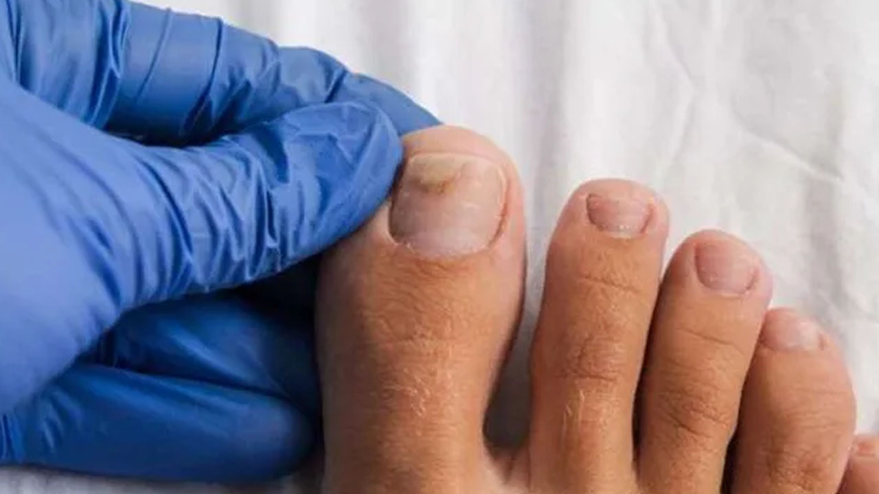 Foto - Tırnak mantarı için bitkisel tedavi: Ayak altına yapın, bu yöntemle 3 günde kurtulun! 