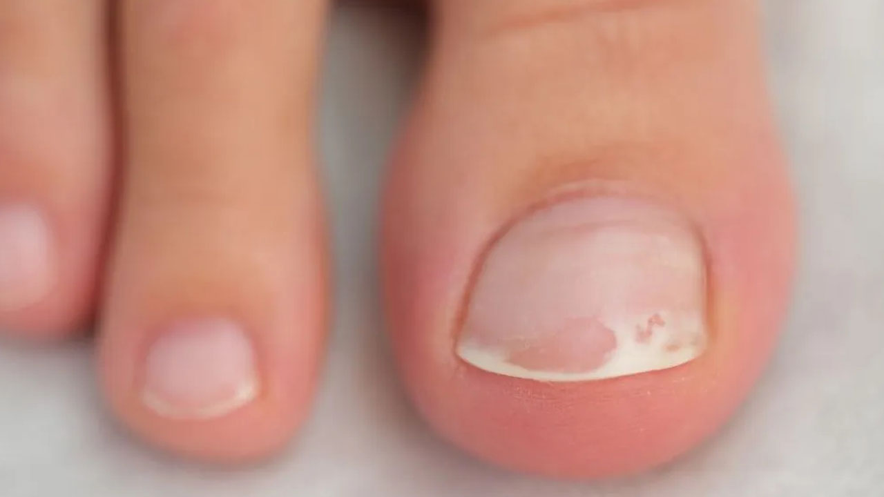 Foto - Tırnak mantarı için bitkisel tedavi: Ayak altına yapın, bu yöntemle 3 günde kurtulun! 