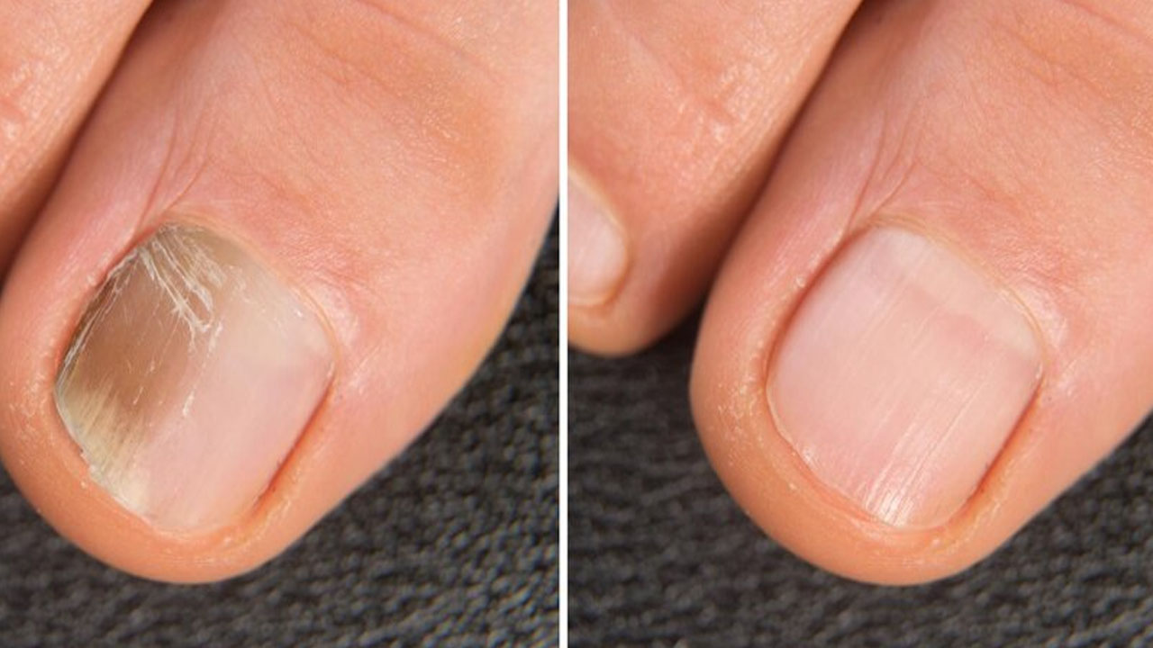 Foto - Tırnak mantarı için bitkisel tedavi: Ayak altına yapın, bu yöntemle 3 günde kurtulun! 