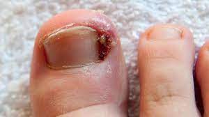 Foto - Tırnak mantarı nedir? Ayak mantarına çözüm: Binlerce kişinin tek tek en beğenilen önerileri! Bunu da yaptılar