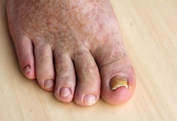 Tırnak mantarına doğal çözüm