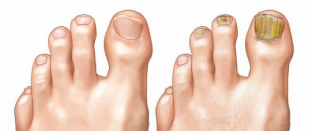 Foto - Tırnak mantarından kurtulmak bu kadar basitmiş! İlgili şok detay: Hemen böyle temizleyin! Bunu yapmanız lazım
