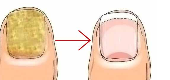 Tırnak mantarından kurtulmak bu kadar basitmiş! İlgili şok detay: Hemen böyle temizleyin! Bunu yapmanız lazım