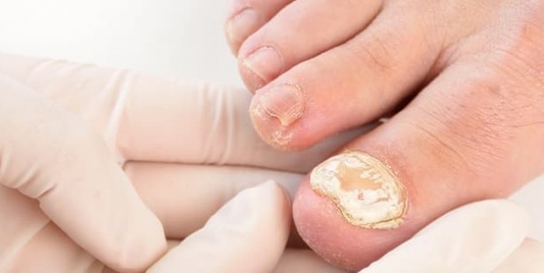 Foto - Tırnak mantarını yok eden doğal yöntem: 3 günde son verin! Nasıl önlenir? Kullananlar şikayetten vazgeçti