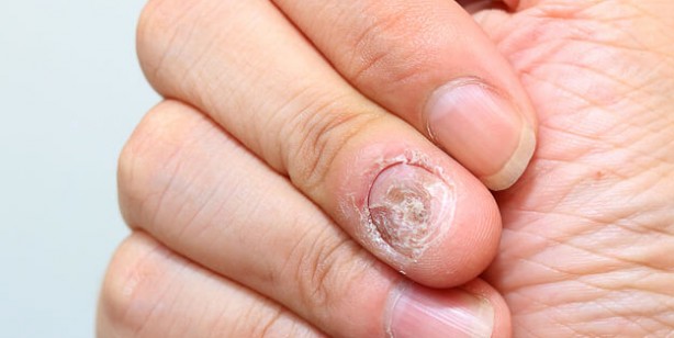 Foto - Tırnak mantarını yok eden doğal yöntem: 3 günde son verin! Nasıl önlenir? Kullananlar şikayetten vazgeçti