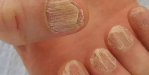 Foto - Tırnak mantarını yok eden doğal yöntem: 3 günde son verin! Nasıl önlenir? Kullananlar şikayetten vazgeçti
