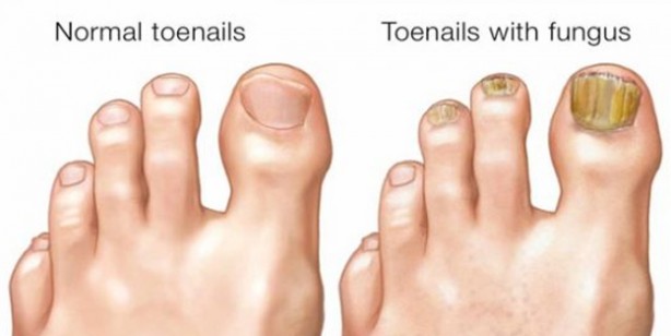 Foto - Tırnak mantarını yok eden doğal yöntem: 3 günde son verin! Nasıl önlenir? Kullananlar şikayetten vazgeçti