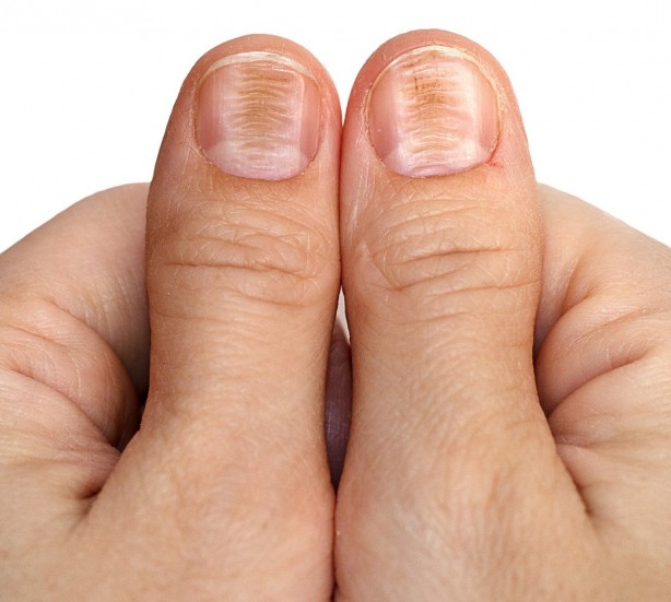 Foto - Tırnak rengindeki değişikliği hafife almayın