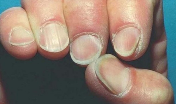 Tırnak rengindeki değişikliği hafife almayın