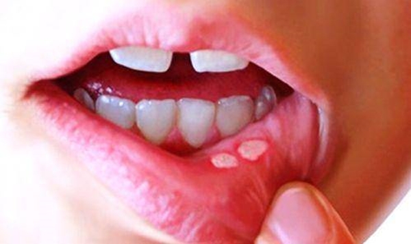 Foto - Tırnak yemek kalp hastalıklarını tetikliyor!