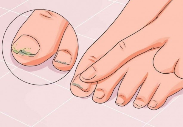 Foto - Tırnaklar nasıl kesilmeli! Uzmanlar uyardı