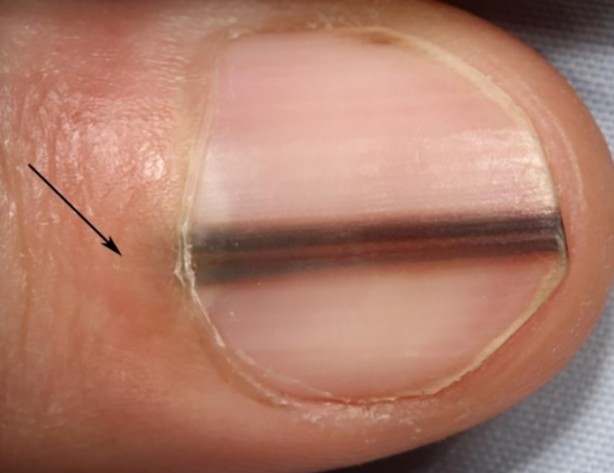 Foto - Tırnaklarda oluşan siyah çizgilerin anlamı nedir?