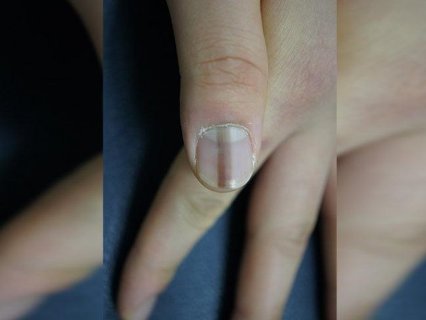 Foto - Tırnaklarda oluşan siyah çizgilerin anlamı nedir?