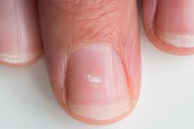 Foto - Tırnaklardaki bu beklenmedik belirti eğer böyle varsa aman dikkat, durum ciddi! Herkes konuşuyor