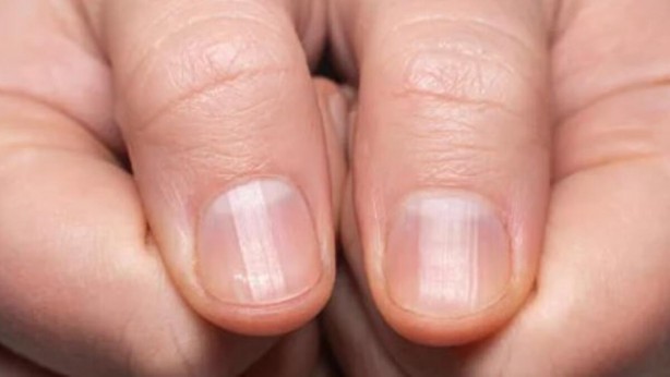 Foto - Tırnaklardaki bu belirti hastalık habercisi olabilir