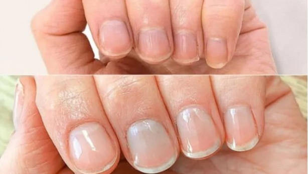 Foto - Tırnaklardaki siyah çizgilere dikkat: Uzmanı uyardı!