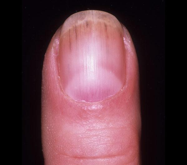 Foto - Tırnaklardaki siyah çizgilere dikkat: Uzmanı uyardı!