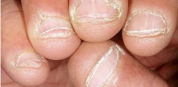 Foto - Tırnaklardaki siyah çizgilere dikkat: Uzmanı uyardı!