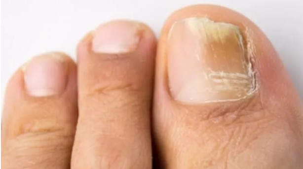 Foto - Tırnaklardaki siyah çizgilere dikkat: Uzmanı uyardı!