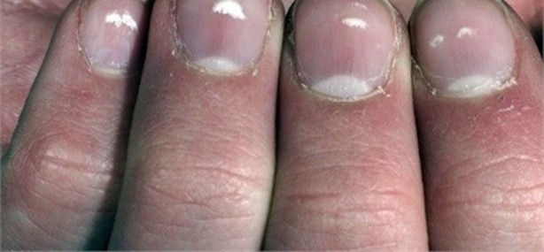Foto - Tırnaklarınızda beyaz leke varsa dikkat!